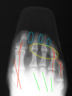 Left-X-ray