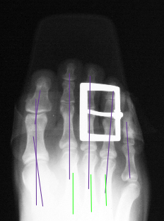 Right-X-ray