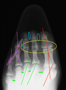 Left X-ray